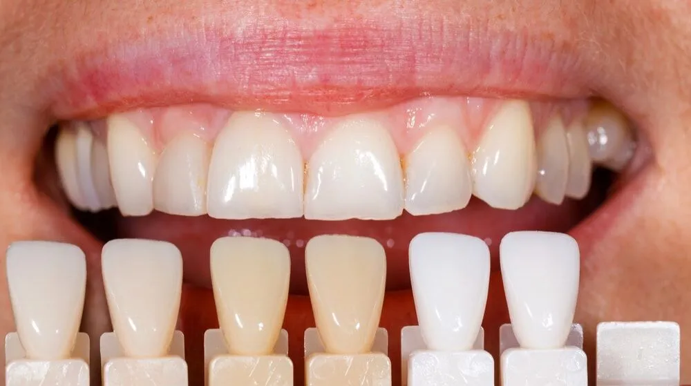What Happens If You Overdo Laser Whitening Crawley