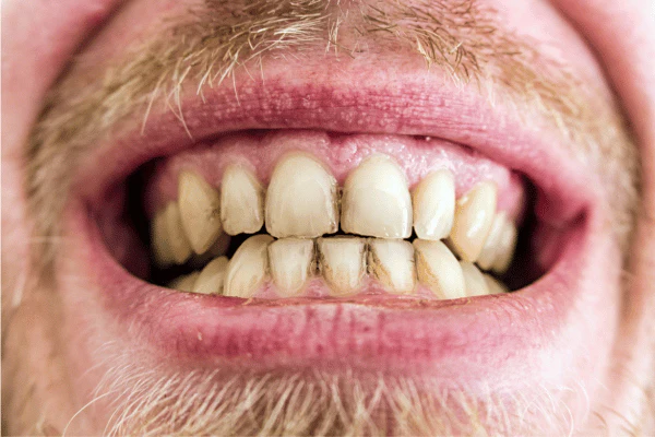 Does Laser Teeth Whitening Work on Coffee, Tea, or Smoking Stains Crawley
