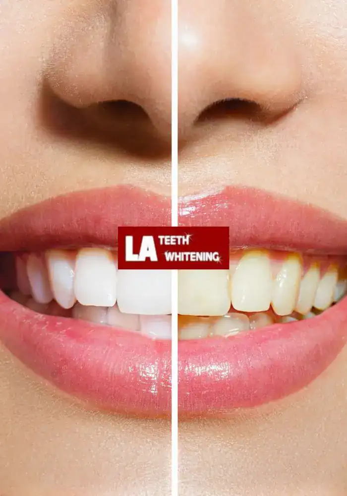 How Safe Is Laser Teeth Whitening for Teenagers and Adults Crawley